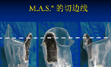 新型MAS假肢接受腔|佳满假肢